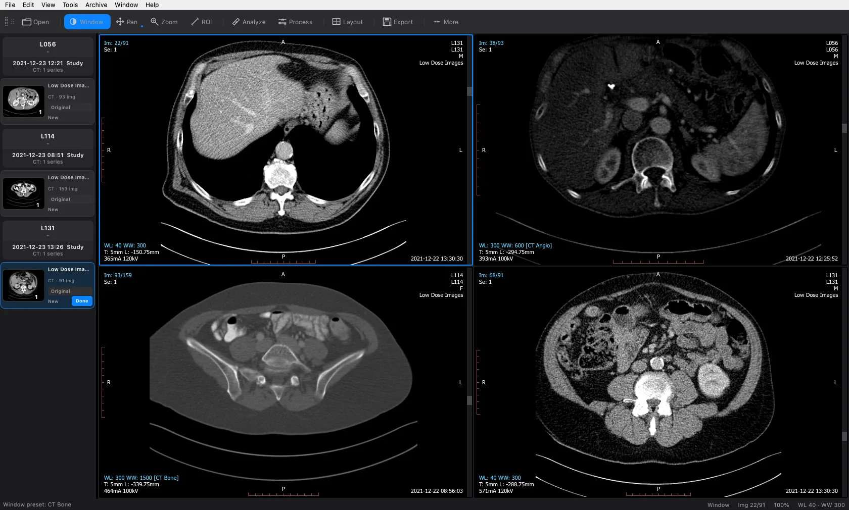 Four panels showing three different de-identified CT studies at once: two panels of one study at a soft-tissue window, one at the CT Angio preset reading WL 300 WW 600, and one at the CT Bone preset reading WL 300 WW 1500, with all three studies listed in the rail on the left.