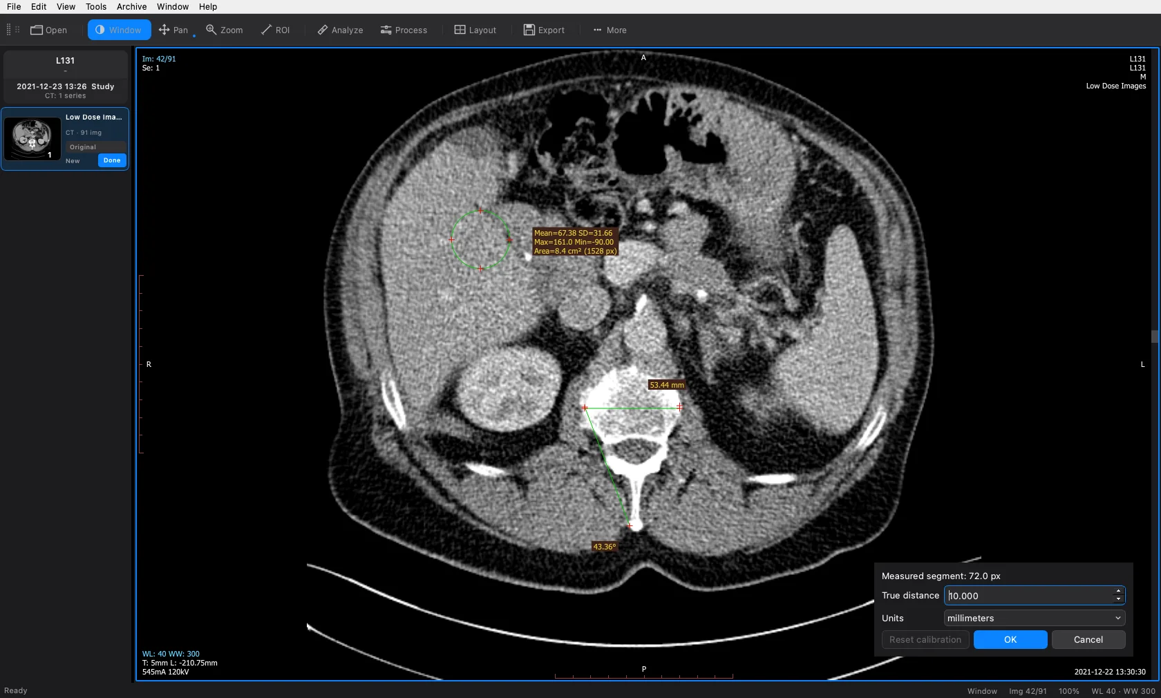 An abdominal CT slice with an elliptical region over the liver reading mean 67.38 and SD 31.66, a length across the vertebral body reading 53.44 mm, an angle of 43.36 degrees across the vertebra, and the calibration dialog open.